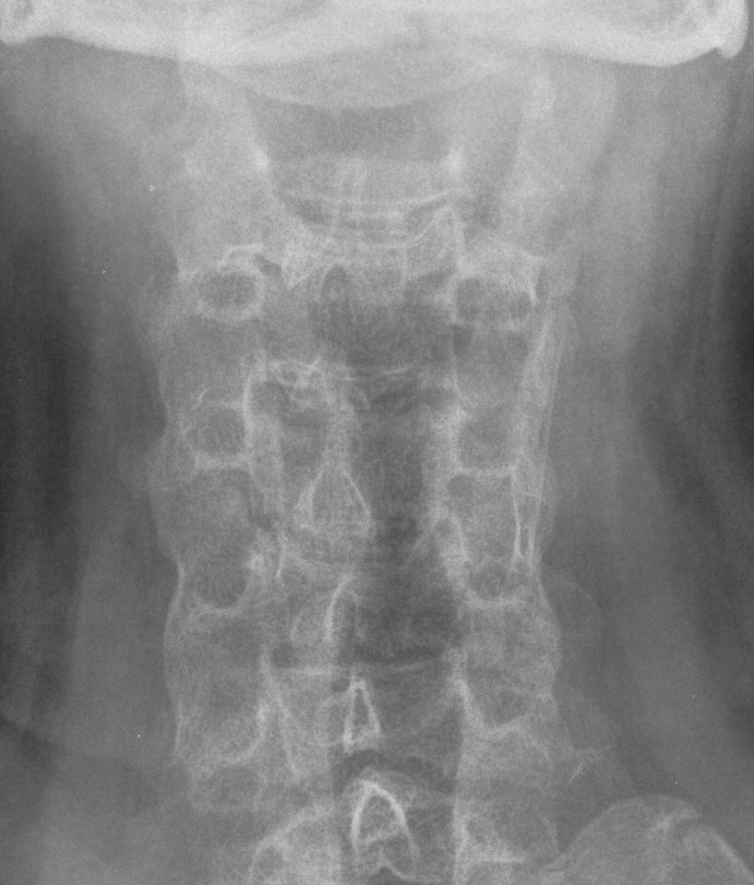 Ankylosing Spondylitis AP C Spine